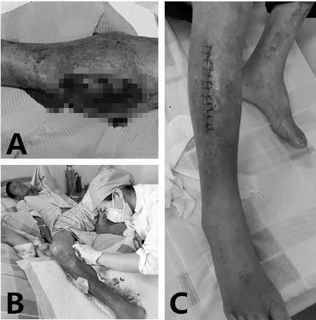 一条腿截肢了什么感觉,一条腿截肢了犯了重罪怎么办