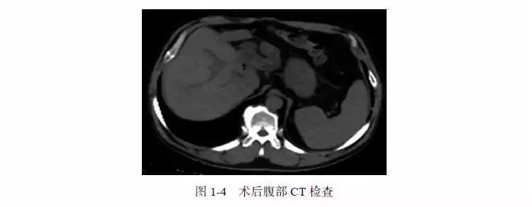 igg4疾病胆管炎会引起ca199升高吗,igg4相关性胆管炎误诊为胆管癌