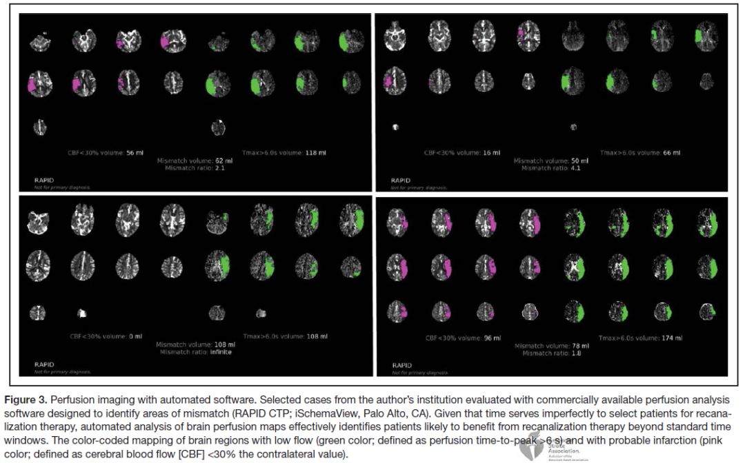 缺血性脑卒中静脉溶栓专家共识,急性缺血性卒中溶栓治疗临床需求