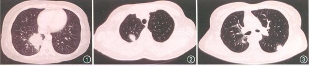 igg4相关性疾病中医辨证论治,igg4相关性眼病最新研究成果