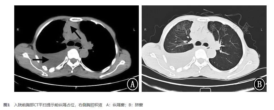 胸腺鳞癌临床出现的几率是多少,胸腺鳞癌一期高分化能活十年吗