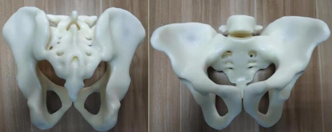 攀枝花三帝科技：3D打印助力髋关节患者骨盆修复