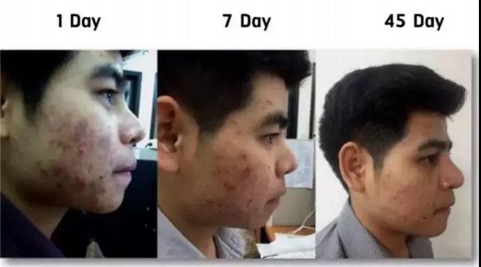 1分钱祛痘神器,祛痘神器0元领取