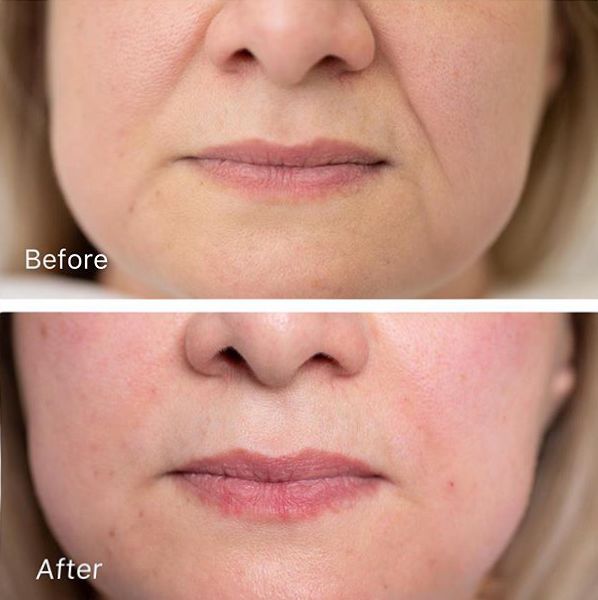 法令纹又黑又长,法令纹又深又长好吗