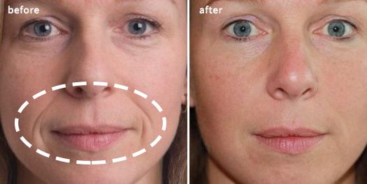 法令纹和眼纹怎么才能有效改善,法令纹贴眼贴有用吗