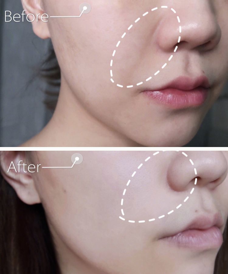 消除眉间法令纹最有效的方法,眉间纹和法令纹医美