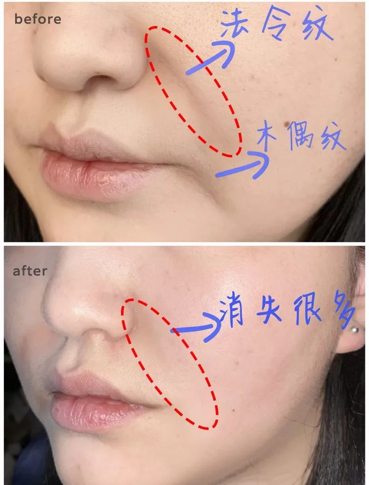 消除眉间法令纹最有效的方法,眉间纹和法令纹医美