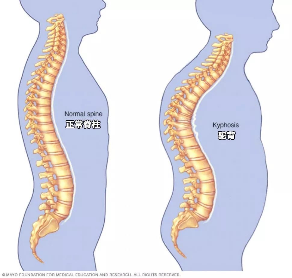 背书包驼背怎么纠正,小孩背书包导致驼背怎么矫正