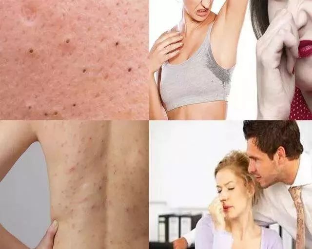 可美金箔祛痘螨虫皂,除螨皂能祛螨虫吗