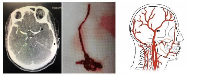 急性脂肪栓塞、神经白塞病、NMOSD极后区综合征丨3分钟读片·第11期