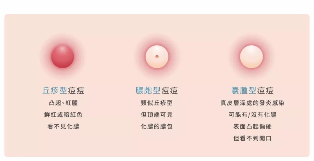 长痘不能吃什么辣的食品,长痘忌口辛辣食物有哪些