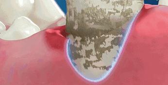 美白黄牙烟渍最好的牙膏,比洗牙还干净的美白牙膏适合牙黄