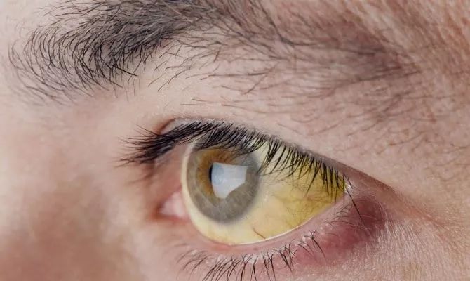 如何治疗先天性胆红素血症,先天性高胆红素血症需要治疗吗