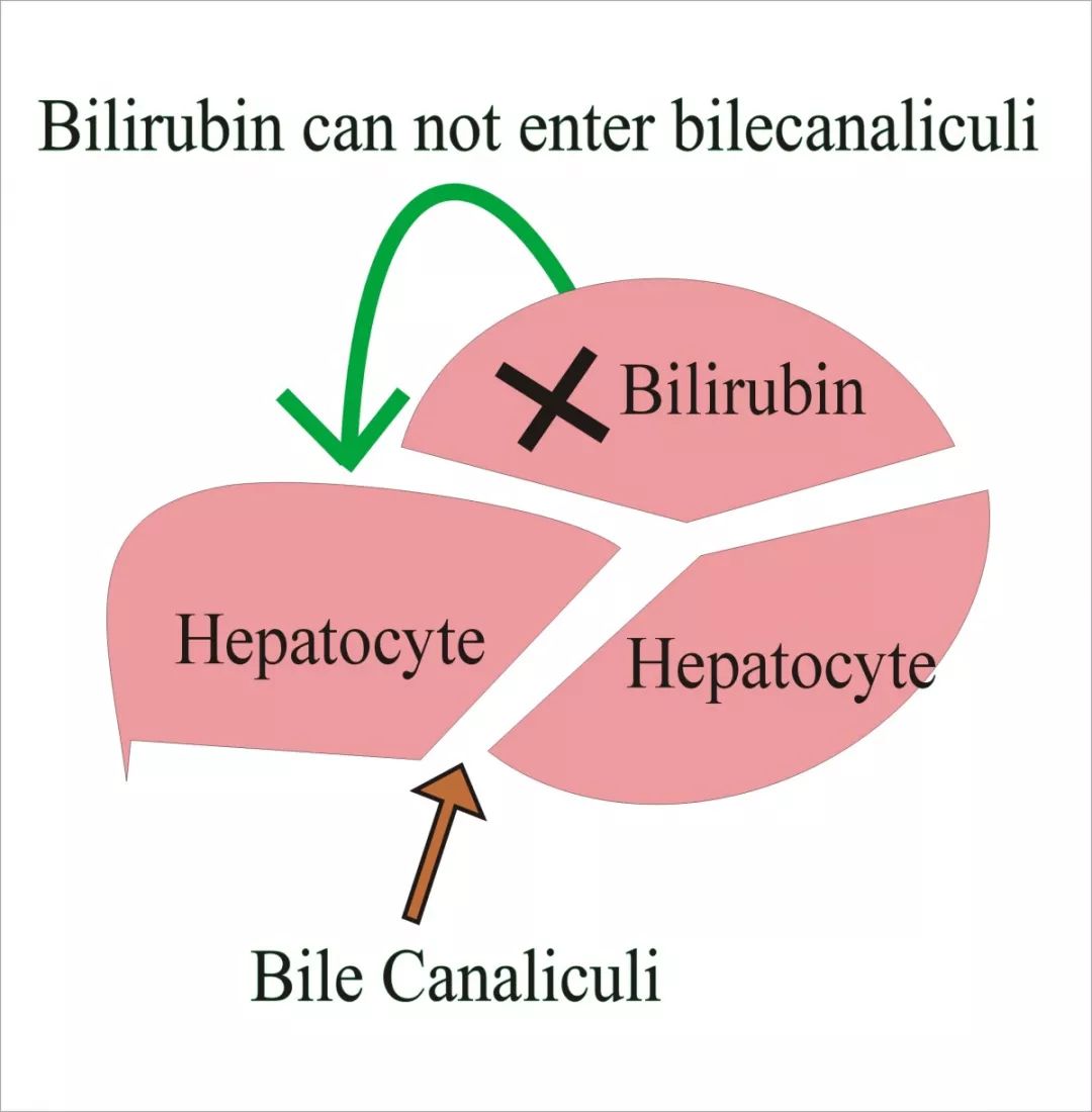 高胆红素脑病四大临床表现,胆红素高症状有哪些