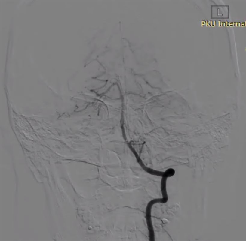 物华天宝·第7期｜脑部长型巨大夹层动脉瘤的4个密网支架桥接治疗复查治愈（附复查CTA结果）