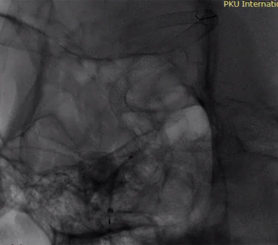 物华天宝·第7期｜脑部长型巨大夹层动脉瘤的4个密网支架桥接治疗复查治愈（附复查CTA结果）