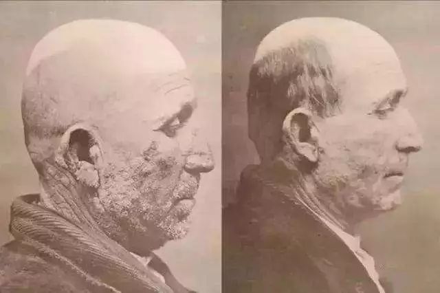 诺贝尔奖免疫治疗法,以毒攻毒效果甚微