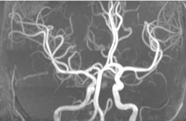 Rasmussen脑炎、结核性肉芽肿、脑发育性静脉畸形丨3分钟读片·第13期,下）