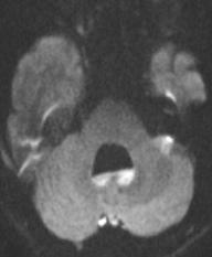 Rasmussen脑炎、结核性肉芽肿、脑发育性静脉畸形丨3分钟读片·第13期,下）