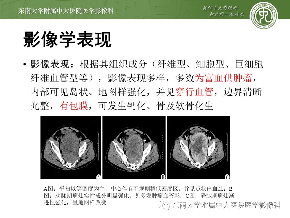 侵袭性纤维瘤影像学表现,侵袭性纤维瘤病影像上易诊断吗