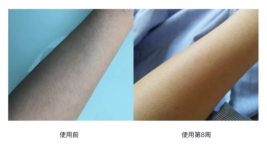 不要错过脱毛好季节,别再错过脱毛最佳季节