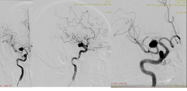治疗颅内动脉瘤新型密网支架,密网支架处理动脉瘤的风险
