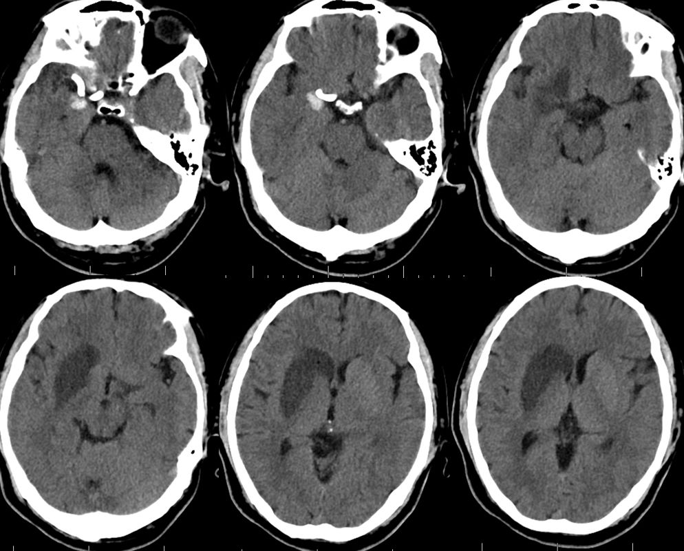 治疗颅内动脉瘤新型密网支架,密网支架处理动脉瘤的风险