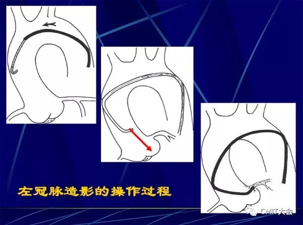 冠脉造影技术成熟不,跟我学技术分析从入门到精通