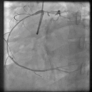 冠脉造影技术成熟不,跟我学技术分析从入门到精通