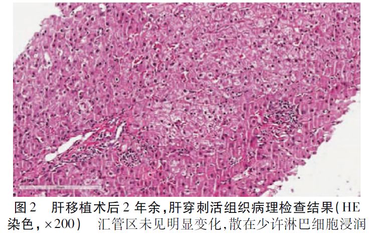 硬化性胆管炎igg4正常吗,igg4相关性硬化性胆管炎诊疗进展