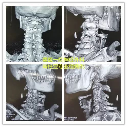 颈椎骨折脱位合并脊髓损伤,颈椎骨折脊髓损伤案例