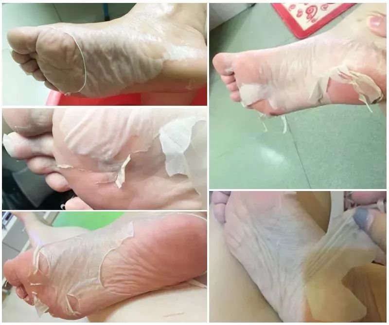 娇嫩双足|堪比“换皮术”的逆天足膜！让双脚像剥鸡蛋壳一样轻松换新皮！60分钟还你柔嫩美足