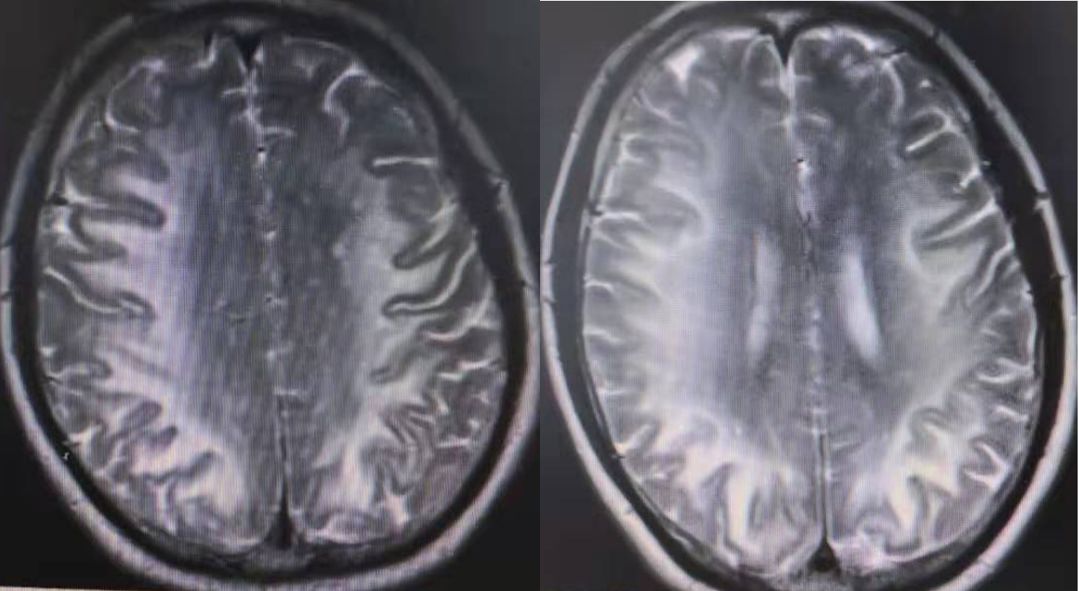 Whipple病、纹状体手、神经结节病、脱髓鞘假瘤丨3分钟读片·第16期