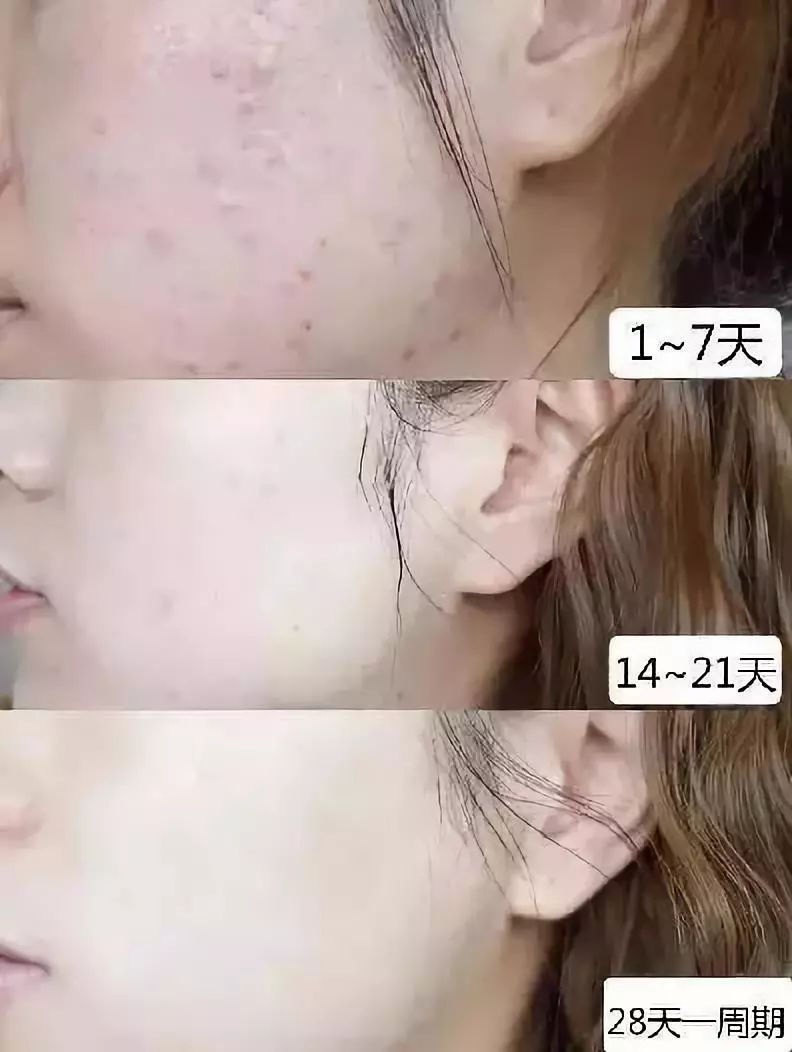 痘痘闭口里面有油脂,鼻子上的痘痘是青春痘还是粉刺