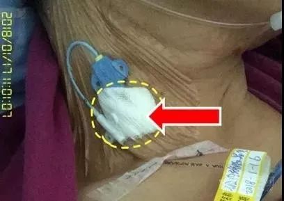 留置针u型敷贴正确撕法,留置针正确固定图片ppt