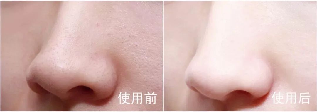 去黑头角质平价水乳,去黑头日本洗面奶