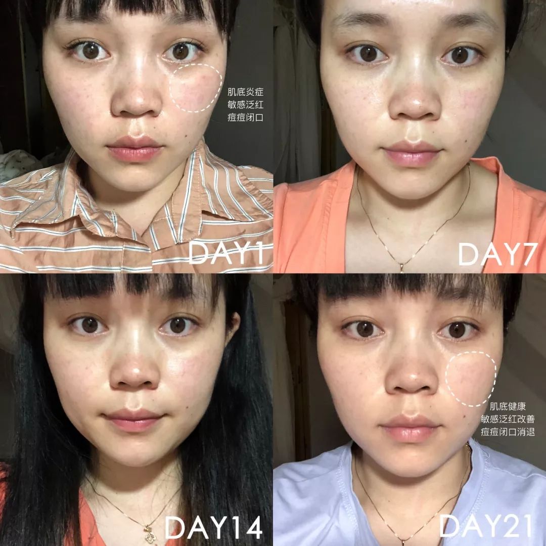 肌诊室水光肌挑战,肌诊室修复