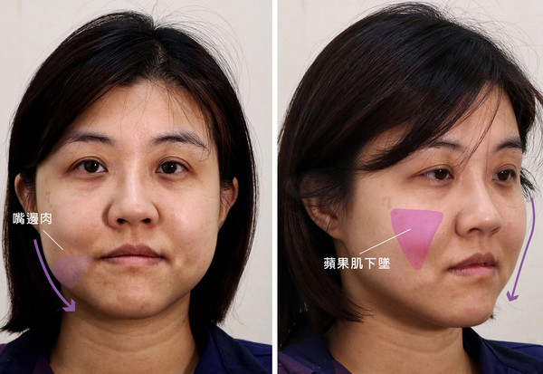 脸下垂提拉紧致图片,提拉下颚线打造小v脸