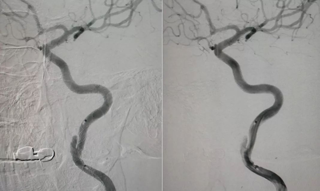 中医治疗脑夹层动脉瘤,3d演示夹层动脉瘤支架治疗