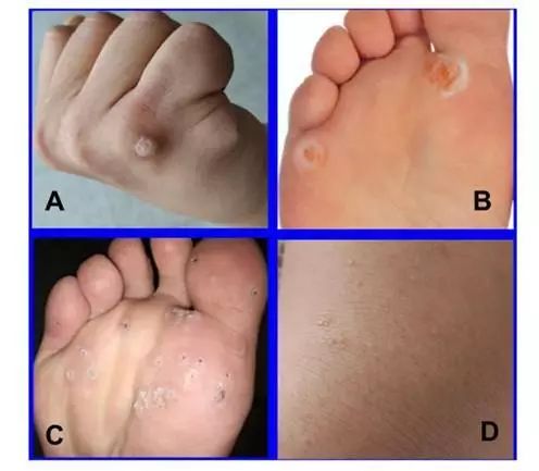 鸡眼和疣如何区别,掌跖疣是不是鸡眼