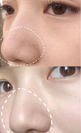 草莓鼻去黑头好物推荐使用,草莓鼻去黑头导出液