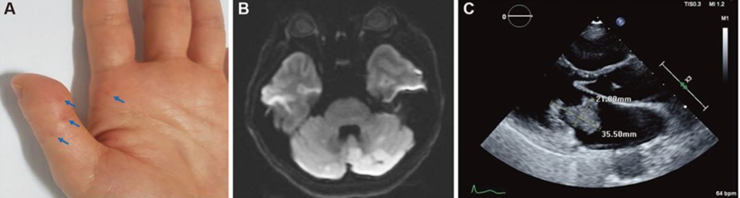 矛盾反应、Carney综合征、脑梗死、笑气中毒丨3分钟读片·第19期
