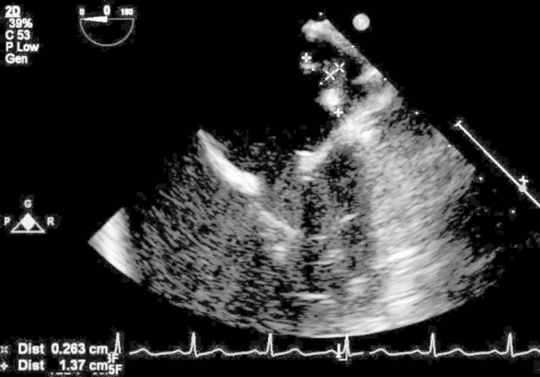 感染性心内膜炎的护理常规记录,新生儿感染性心内膜炎