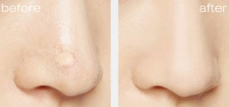 11款热门遮瑕合集,遮瑕笔强力遮斑测评