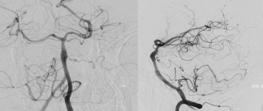 穆如清风·第13期｜Tubridge治疗基底动脉巨大夹层动脉瘤