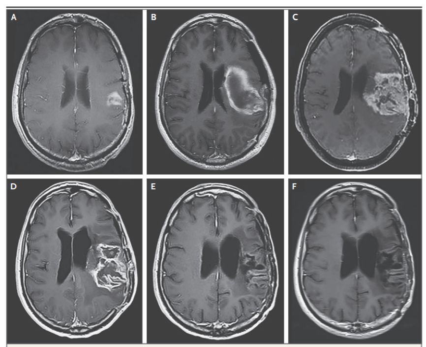 母髓细胞恶性脑瘤能治愈吗,恶性脑瘤有治愈的吗