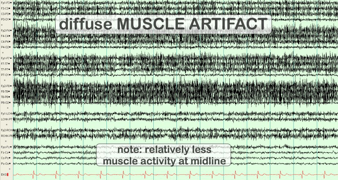 脑电图伪差图,脑电图伪差图谱