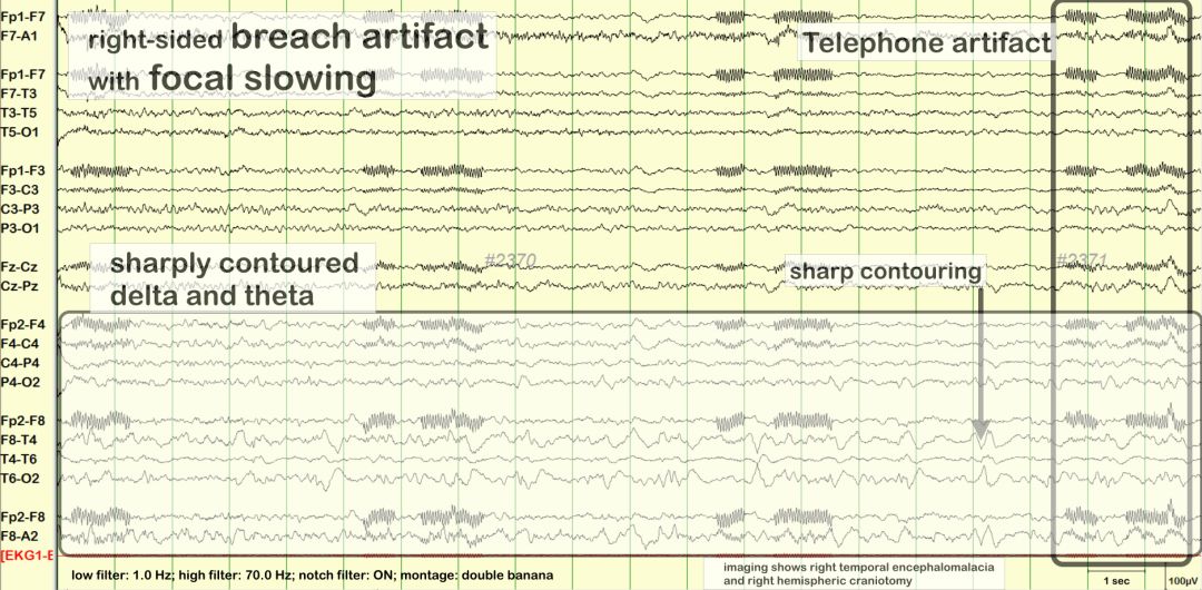 脑电图伪差图,脑电图伪差图谱