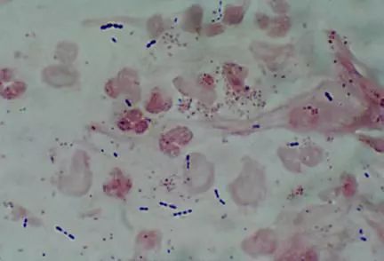 26张图，搞懂细菌性肺炎与病毒性肺炎