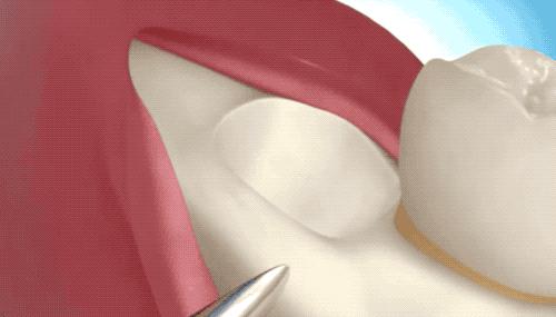 拔智齿的全过程科普,拔智齿细致操作过程
